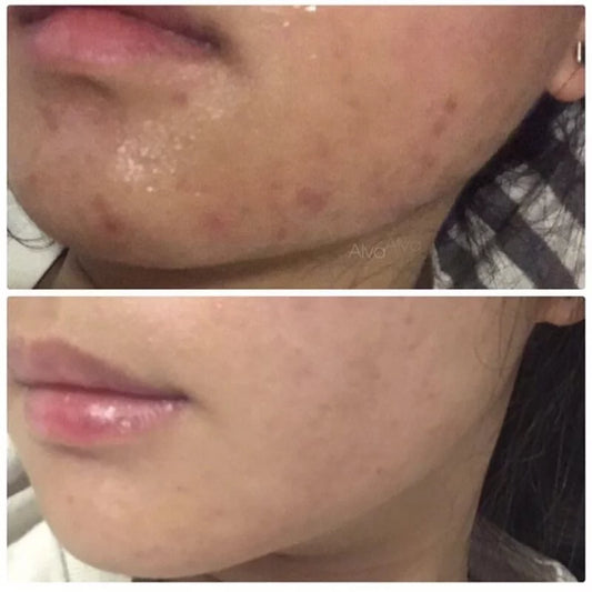 套裝A (玫瑰痤瘡/暗瘡肌用)