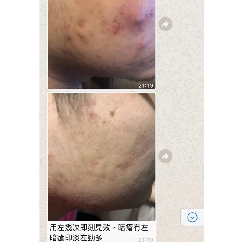 套裝A (玫瑰痤瘡／暗瘡肌用）